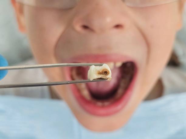 Best Emergency Dentist for Lost Fillings or Crowns in East Ithaca, NY